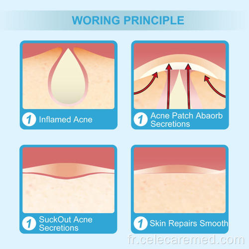 Acné pimple patch hydrocolloïde acné spot sticks